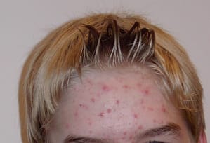 Acne hos en 14-årig pojke under puberteten.