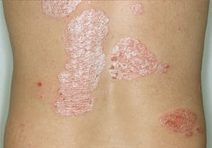 Psoriasis ger röda, fjällande utslag eller fläckar som ibland kliar.